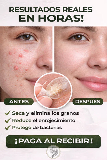 Parches Para Acne DESARROLLADOS CON TECNOLOGÍA HIDROCOLOIDE / PACK X 6 HOJAS